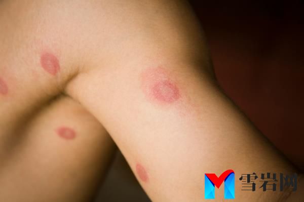 Researchers caution that TMVII rashes differ from the classic circular ex<em></em>pression of ringworm seen here.