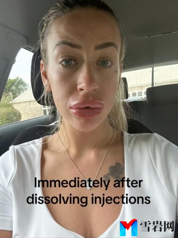 Her lips were swollen immediately following the treatment.