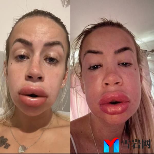 Courtney Taaffe ended up in the hospital after havin<em></em>g her lip filler dissolved. 